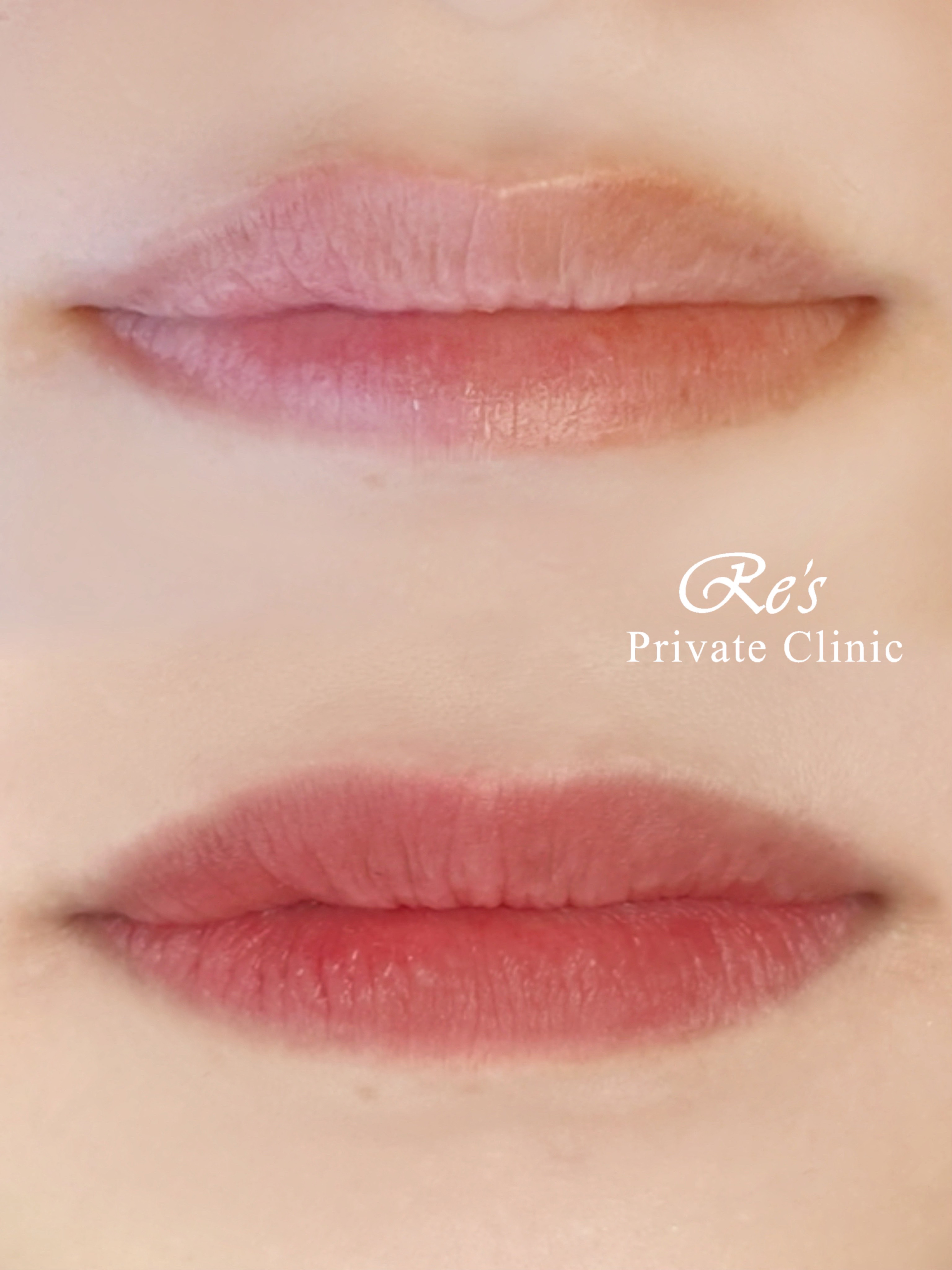 リーズプライベートクリニック｜リップアートメイクの症例