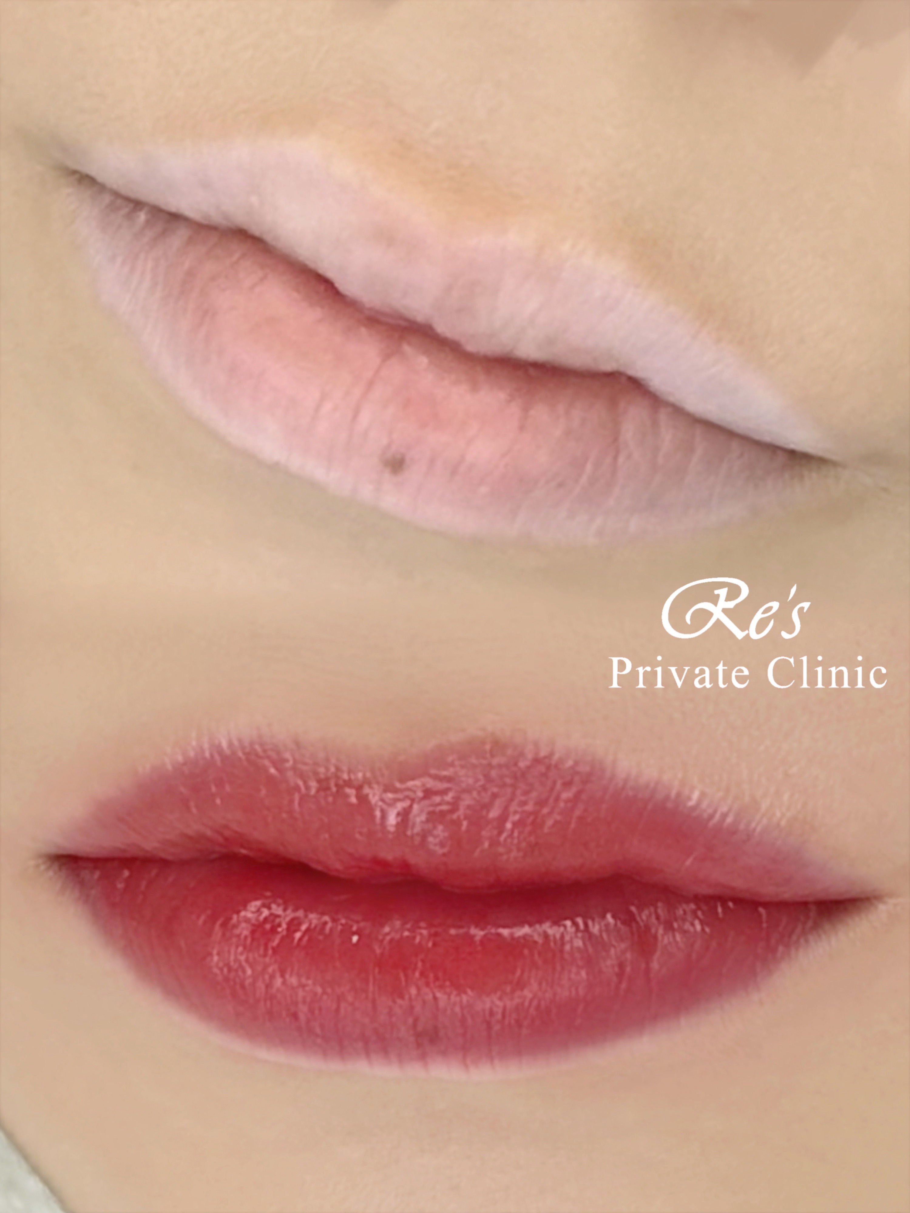 リーズプライベートクリニック｜リップアートメイクの症例